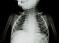 Chest x-ray Royalty Free Stock Photo