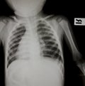Chest x-ray Royalty Free Stock Photo