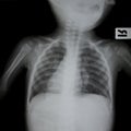 Chest x-ray Royalty Free Stock Photo