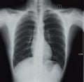 Chest X-rays Royalty Free Stock Photo