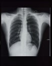 Chest X-rays Royalty Free Stock Photo