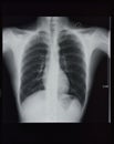 Chest X-rays