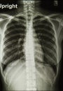 Chest X-rays image Royalty Free Stock Photo