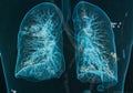 Chest X-rays lungs 3d image Royalty Free Stock Photo