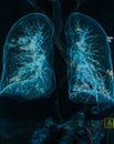 Chest X-rays lungs 3d image Royalty Free Stock Photo