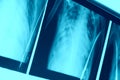 Chest X-rays on negatoscope. Royalty Free Stock Photo