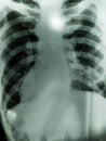 Chest x-rays show advanced pulmonary tuberculosis. Royalty Free Stock Photo