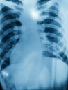 Chest x-rays show advanced pulmonary tuberculosis. Royalty Free Stock Photo