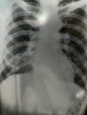chest x-rays show advanced pulmonary tuberculosis. Royalty Free Stock Photo