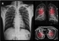 Chest X-rays under 3d image Royalty Free Stock Photo