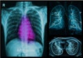 Chest X-rays under 3d image Royalty Free Stock Photo