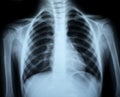 Chest xray