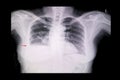 Chest xray of cardiomegaly , pulmonary edema and pleural effusion