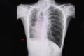 Chest xray film of a patient with bronchiectasis