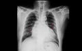cardiomegaly and multiple fractures of ribs