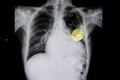 a cardiac pacemaker Royalty Free Stock Photo