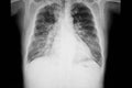 chest xray film of a patient with cardiomegaly Royalty Free Stock Photo