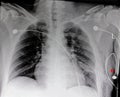 subcutaneous emphysema