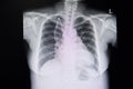 chest xray film of a patient with double lumen catheter Royalty Free Stock Photo