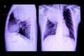 anterior mediastinal mass