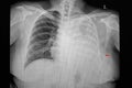 A chest xray film of a patient with massive pleural effusion