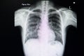 A chest xray film of a patient with pneumonia