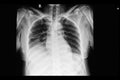 Pulmonary edema