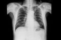 A chest xray film of a patient with right pulmonary hamartoma