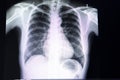 small nodule in the lung Royalty Free Stock Photo