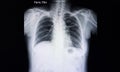 Chest xray film of a patient with tuberculosis