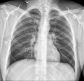 Chest Xray, Heart, Lungs, Bones and Rib Cage Royalty Free Stock Photo