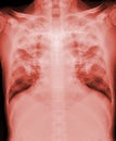 Chest xray image showing TB,tuberculosis or covid-19