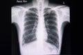 a chest xray with multiple nodular infiltrations in the lungs Royalty Free Stock Photo