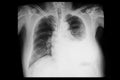 A chest xray of a patient with left pleural effusion Royalty Free Stock Photo