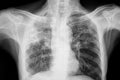Chest xray of the patient with lungs tuberculosis Royalty Free Stock Photo