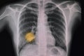 Chest xray of a patient with primary lung tumor and pneumonia