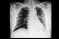 a chest xray of a patient with rib fractures and pleural effusion and subcutaneous emphysema