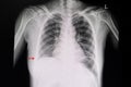 Chest xray of a patient showing free air in the abdominal cavity Royalty Free Stock Photo