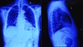 Chest ct xray scan film illuminated by blue light