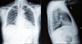 Chest xray scan Royalty Free Stock Photo