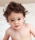 Chicken pox rash Royalty Free Stock Photo