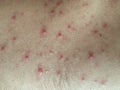 Chicken pox rash on the body.Chickenpox is an infection caused by the varicella zoster virus.