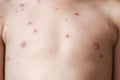 Chicken pox rash on young boy body.Chickenpox is an infection caused by the varicella zoster virus. It begins as a blister-like