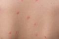 Chicken pox rash on young boy body.Chickenpox is an infection caused by the varicella zoster virus. It begins as a blister-like