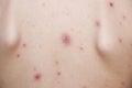 Chicken pox rash on young boy body.Chickenpox is an infection caused by the varicella zoster virus. It begins as a blister-like