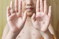 Chicken pox rash on young boy body.Chickenpox is an infection caused by the varicella zoster virus. It begins as a blister-like Royalty Free Stock Photo