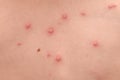 Chickenpox Royalty Free Stock Photo