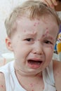 Chickenpox