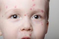 Chickenpox