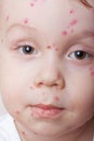 Chickenpox Royalty Free Stock Photo